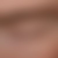 Alopecia areata of the eyelashes: since 2 years recurrent loss of the eyelashes (here on the uppe...