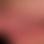 Aphthe habituelle: umschriebene rezidivierenden Aphthen, hier mit horizontaleem&nbsp; Pfeil marki...
