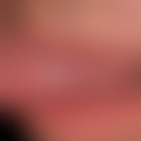 Aphthae habituelle: circumscribed recurrent aphthae, here marked with a horizontal arrow; vertica...