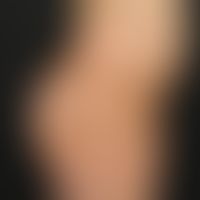 Becker-Naevus: flat hyperpigmentation in the area of the right hip in a 7-year-old boy, existing ...