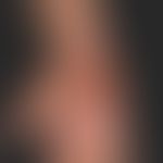 Calcinosis (cutis) dystrophica: Ursache konnte nicht geklärt werden.
