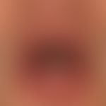 Cheilitis glandularis simplex: only moderately symptomatic cheilits with slightly swollen lower l...