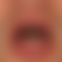 Cheilitis glandularis simplex: only moderately symptomatic cheilits with slightly swollen lower l...