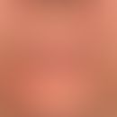 Perioral dermatitis: dermatitis that has persisted for months and is resistant to therapy. Interm...