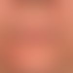 Perioral dermatitis: dermatitis that has persisted for months and is resistant to therapy. Interm...