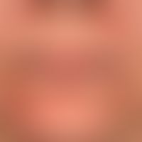 Perioral dermatitis: dermatitis that has persisted for months and is resistant to therapy. Interm...