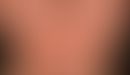 Periorale Dermatitis: seit Monaten persitierende, therapieresistente Dermatitis. Intermittierende...