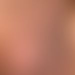 Skrotaldermatitis&nbsp;chronische: chronisch lichenifizierte Skrotalhaut mit aggregierten meist h...