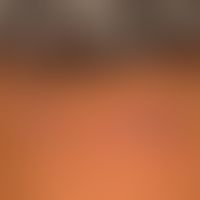 eczema atopic in dark skin): here as partial manifestation of a generalized intrinsic atopic ecze...
