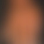 eczema atopic in dark skin): here as partial manifestation of a generalized (face, neck, hands, l...