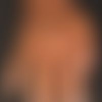 Ekzem atopisches in dunkler Haut): hier als Teilmanifestation eines generalisierten (Gesicht, Nac...