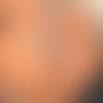 Eczema atopic (partial section of a generlised eczema): severe intrinsic atopic eczema that has b...