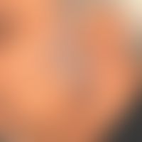Atopische Dermatitis (Teilausschnitt eines generlisierten Ekzems): seit Monaten bestehendes, schw...