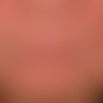 Dermatitis, seborrheic: Blurred, delicately reddened, coarse lamellar scaling, flat, slightly inf...