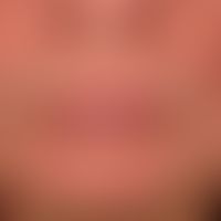 Dermatitis, seborrhoische: Unscharf begrenzte, zart gerötete, groblamellär schuppende, flächige, ...