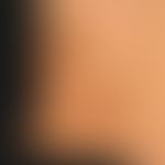 Erythema dyschromicum perstans:&nbsp;49 Jahre alter Mann. Seit mehreren Monaten bestehende, fläch...