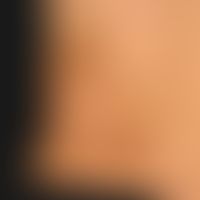 Erythema dyschromicum perstans:&nbsp;49 Jahre alter Mann. Seit mehreren Monaten bestehende, fläch...