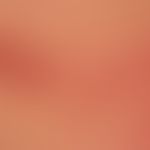 Erythema multiforme: multiple red plaques with central blister formation, on the left edge of the...