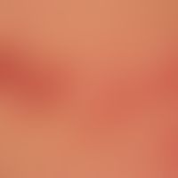 Erythema multiforme: multiple rote Plaques mit zentraler Blasenbildung, am linken Bildrand sind d...