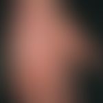 eczema atopic (overview): chronic atopic hand eczema. extensive redness of the entire palm. the c...