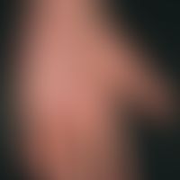 Atopische Dermatitis&nbsp;(Übersicht):&nbsp; Chronisches atopishes Handekzem. Flächige Rötung der...