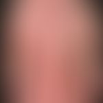 Eczema atopic (overview): severe, universal (erythrodermic) atopic eczema. exacerbation phase sin...