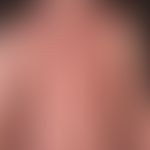 Eczema atopic (overview): severe, universal (erythrodermic) atopic eczema. exacerbation phase sin...