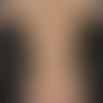 Eczema atopic (purigoform). severe, generalized, severe itching atopic eczema with disseminated, ...