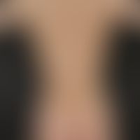 Eczema atopic (purigoform). severe, generalized, severe itching atopic eczema with disseminated, ...