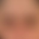 Eyelid dermatitis atopic: brownishhyperpigmentation of the lower lid (more subtle on the upper li...