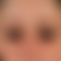 Eyelid dermatitis atopic: brownishhyperpigmentation of the lower lid (more subtle on the upper li...