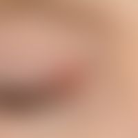 Liddermatitis atopische: immer wieder rezidivierende, umschriebene juckende &nbsp;ekzematöse Reak...