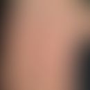 Dermatitis papulosa juvenilis: flat, 0.1-0.3 cm large, hemispherical or roundish, also polygonal,...