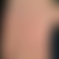 Dermatitis papulosa juvenilis: flat, 0.1-0.3 cm large, hemispherical or roundish, also polygonal,...