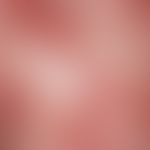 Prurigo nodularis:&nbsp;Nahaufnahme, exkoriierte und exulzerierte, breitbasig aufsitzende Knoten.
