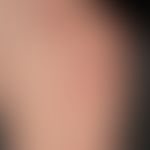 Desiccation dermatitis: slight, pityriasiform scaling with a characteristic craquelée pattern wit...