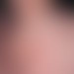 dermatitis, seborrhoeic: 60-year-old patient with blanden own and family history of psoriasis. re...