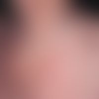 dermatitis, seborrhoeic: 60-year-old patient with blanden own and family history of psoriasis. re...