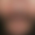 Dermatitis, seborrhoeic: Multiple, chronically stationary, centrofacially localized (also on eyeb...