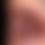 Erythema exsudativum multiforme. multiple, highly acute, 4-day-old, extensive erosions in the are...