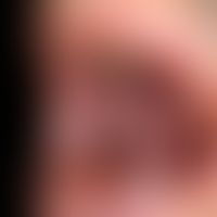 Erythema multiforme (EM-Major-Typ):&nbsp;multiple, hoch akute, seit 4 Tagen bestehende, flächige ...