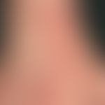 erythema multiforme: detailed picture: suddenly appeared, for 4 days existing, itchy, disseminate...