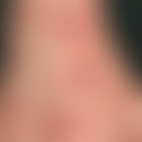 Erythema multiforme: Detailaufnahme: plötzlich aufgetretenes, seit&nbsp;4 Tagen bestehendes, juck...