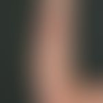 erythema exsudativum multiforme. typical picture with different stages of development of the effl...