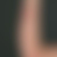 Erythema&nbsp;multiforme:&nbsp;typisches Bild mit unterschiedlichen Entwicklungsstufen der Efflor...