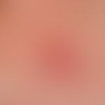 erythema multiforme. characteristic cockades in the area of the palms. acutely occurring, self-li...