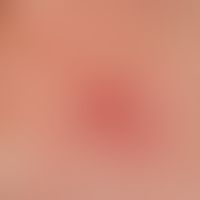 erythema multiforme. characteristic cockades in the area of the palms. acutely occurring, self-li...