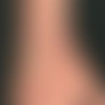 Erythema exsudativum multiforme: detailed pattern with explanations
