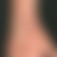 Erythema exsudativum multiforme: detailed pattern with explanations
