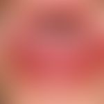 Stevens-Johnson-Syndrom:&nbsp; akut aufgetretene, großflächige, schmerzhafte Erosionen an Lippenr...